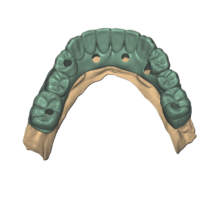 Implants Final View