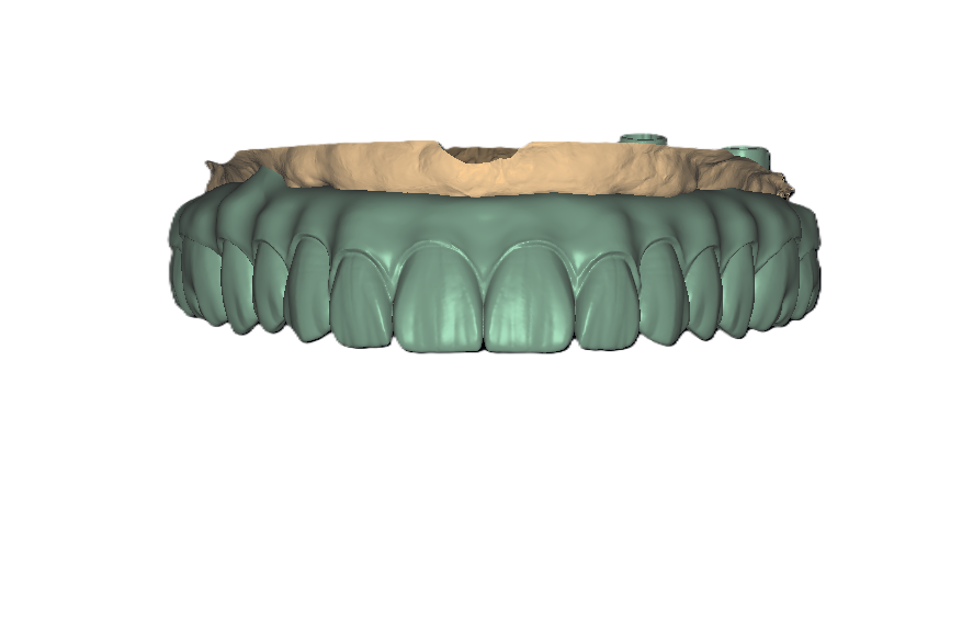Implants Frontal View