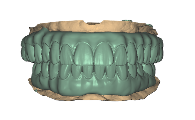 Implants Occlusal View