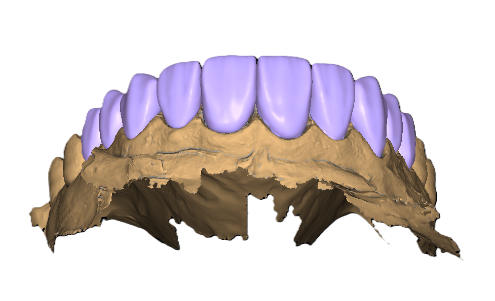 Veneers After