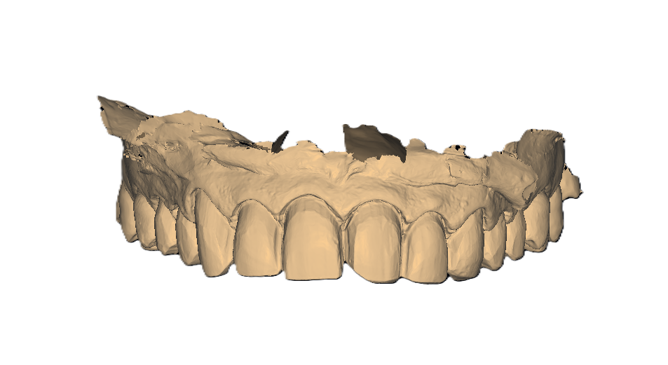 Veneers Before